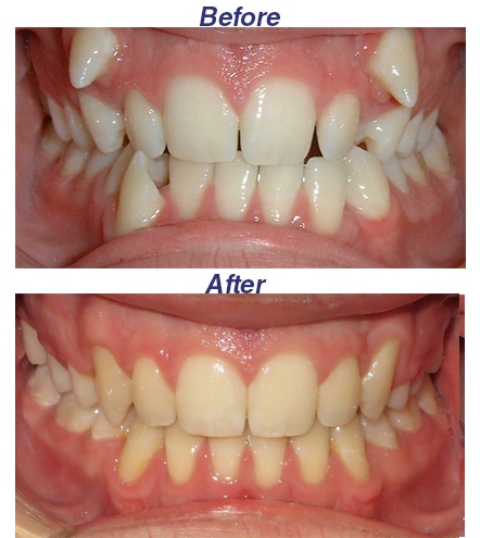 Before and After Honey Orthodontics in Gurnee, IL
