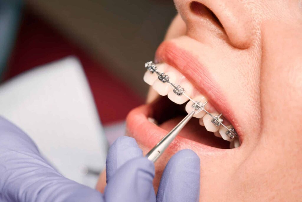 Tips for Eating Well With New Braces Honey Orthodontics in Gurnee, IL.
