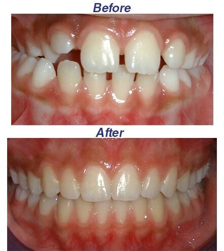 Before and After Orthdontic Results Honey Orthodontics in Gurnee, IL