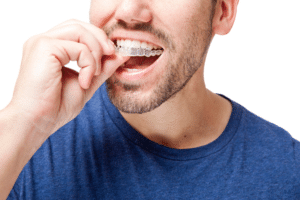 Close-up of a man putting a clear aligner over his upper teeth