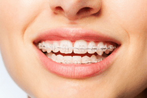 Close-up of a person smiling with clear ceramic braces on their upper and lower teeth.