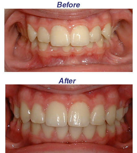 Before and After Honey Orthodontics Gurnee IL